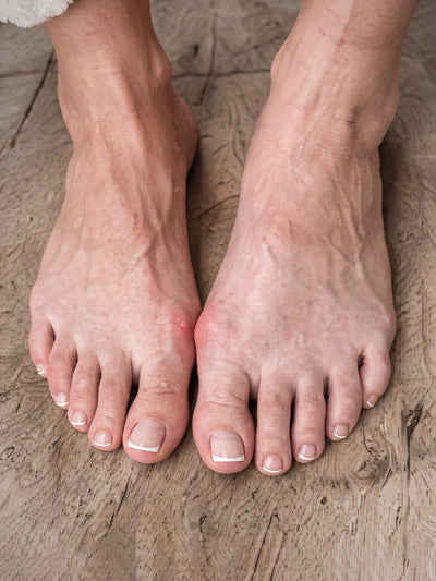 Bunion