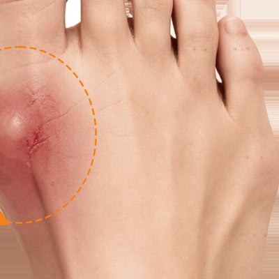 Bunion