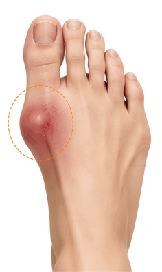 Why Bunions Make Every Step Harder